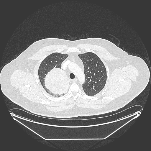 lung_053 真实原始切片